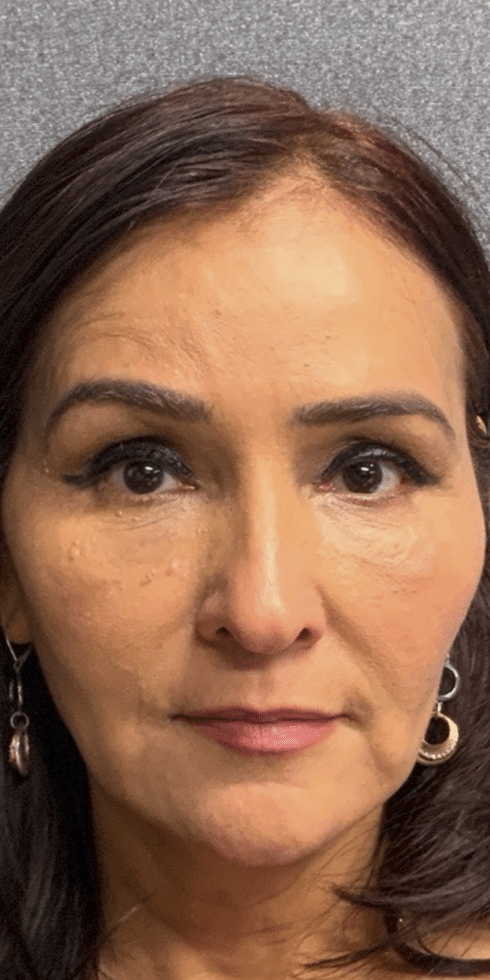 Before Image: Neurotoxin - front