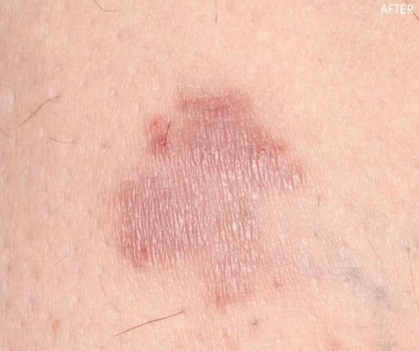 After Image: Renewal Calming Cream for Eczema - front