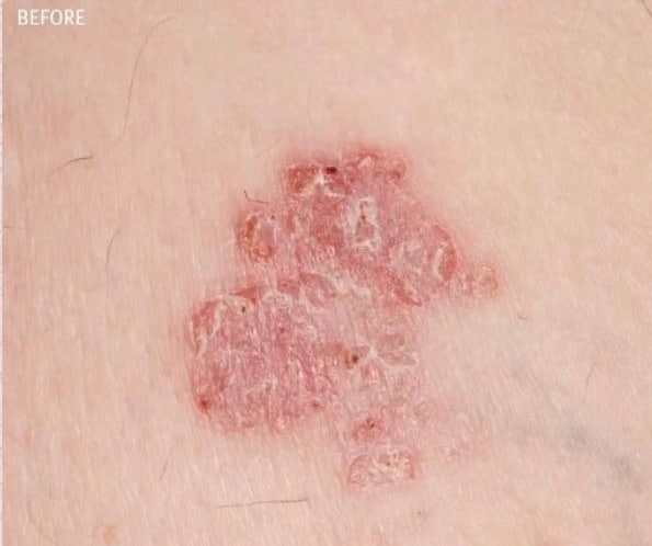 Before Image: Renewal Calming Cream for Eczema - front