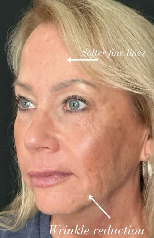 After Image: PDO Threads + Injectables Combination - left-front-oblique