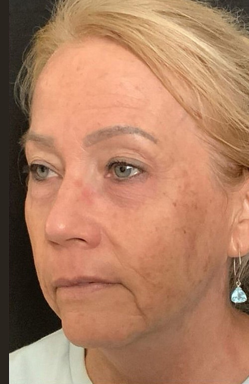 Before Image: PDO Threads + Injectables Combination - left-front-oblique