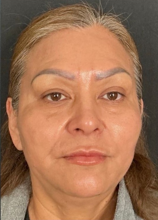 After Image: Nouvaderm, Filler, Face & Neck Threads - front