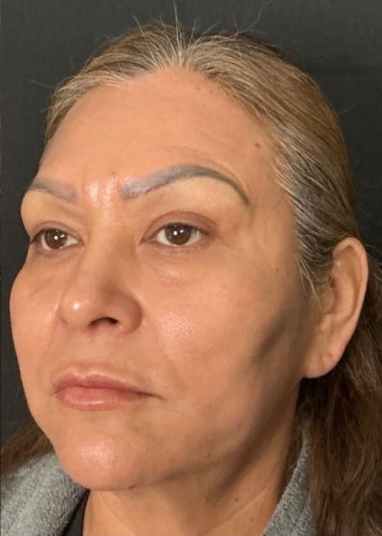 After Image: Nouvaderm, Filler, Face & Neck Threads - left-front-oblique