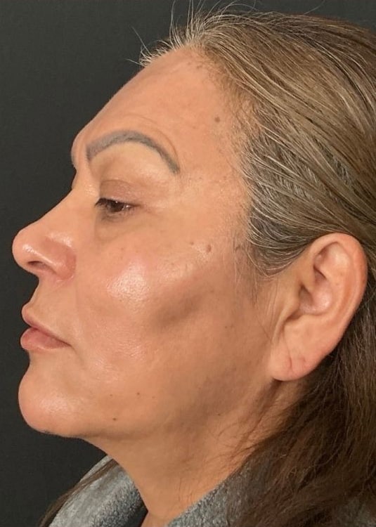 After Image: Nouvaderm, Filler, Face & Neck Threads - left-side