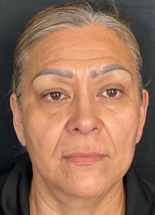 Before Image: Nouvaderm, Filler, Face & Neck Threads - front