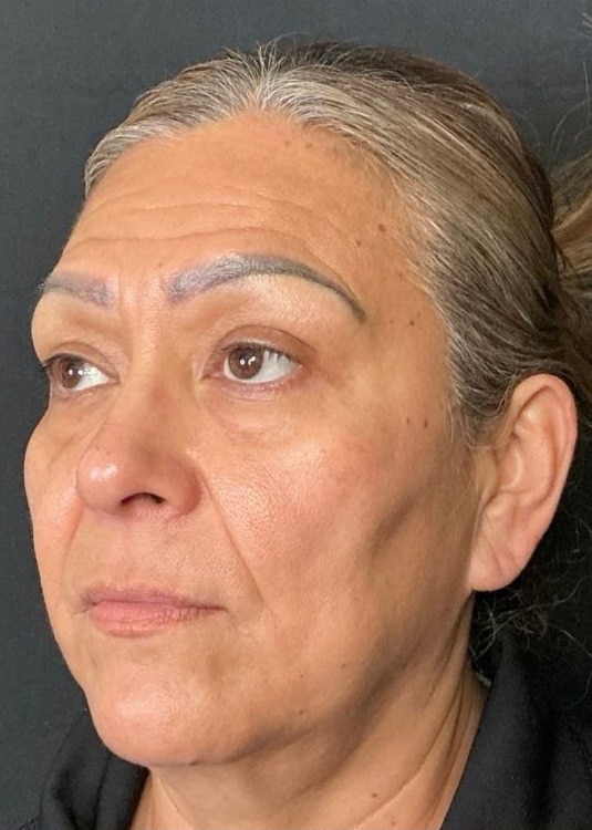 Before Image: Nouvaderm, Filler, Face & Neck Threads - left-front-oblique