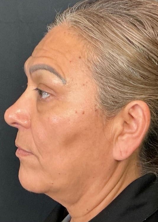 Before Image: Nouvaderm, Filler, Face & Neck Threads - left-side