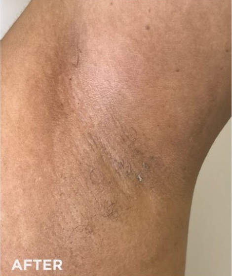 After Image: VI Peel - front