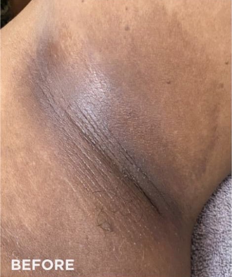 Before Image: VI Peel - front