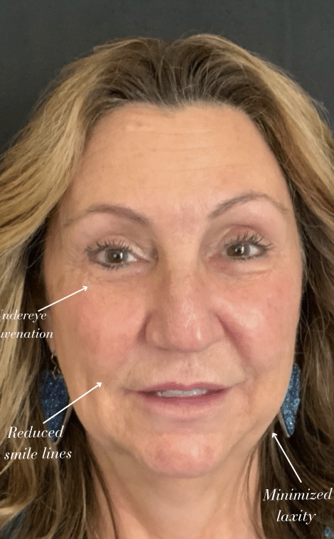 After Image: VI Peel, Aerolase, Sculptra, Jeuveau, Restylane - front