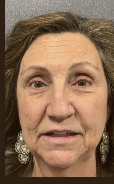 Before Image: VI Peel, Aerolase, Sculptra, Jeuveau, Restylane - front