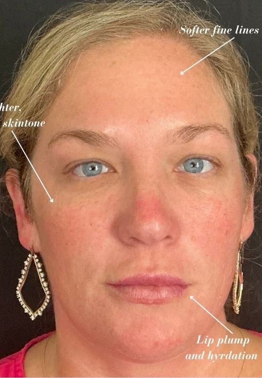 After Image: VI Peel, Versa Lips, Jeuveau, Epionce - front