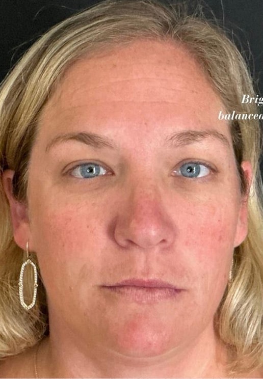 Before Image: VI Peel, Versa Lips, Jeuveau, Epionce - front