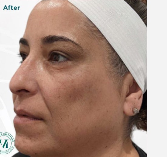 After Image: VI Peel - left-front-oblique