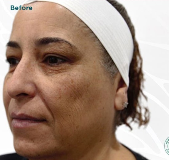 Before Image: VI Peel - left-front-oblique