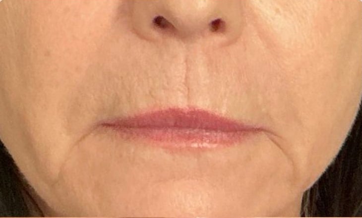 Before Image: Versa – Lips - front