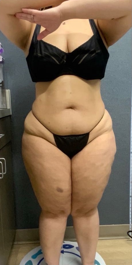 Before Image: Weight Loss - front