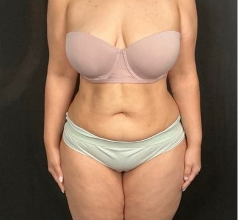 After Image: Weight Loss - front