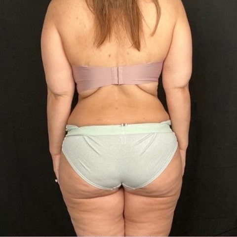 After Image: Weight Loss - back