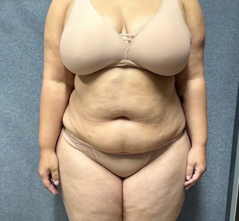 Before Image: Weight Loss - front