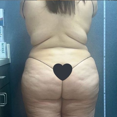 Before Image: Weight Loss - back