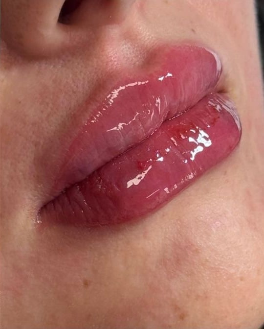 After Image: Lip Filler - right-front-oblique