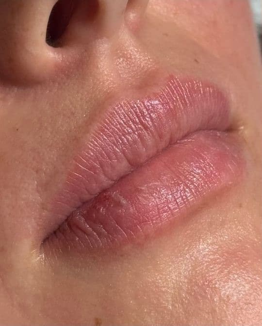 Before Image: Lip Filler - right-front-oblique