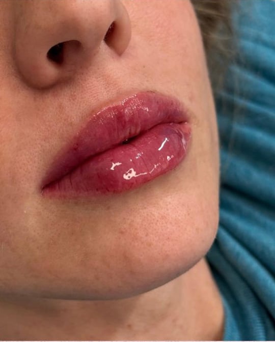 After Image: Lip Filler - right-front-oblique