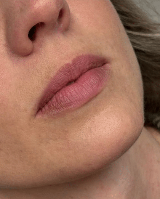 Before Image: Lip Filler - right-front-oblique