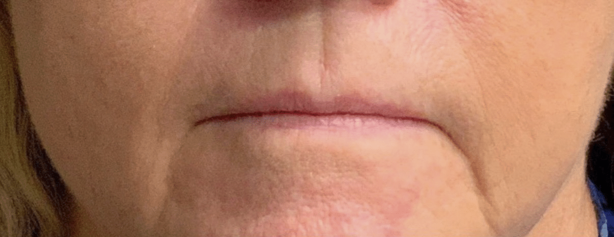 Before Image: Lip Filler - front