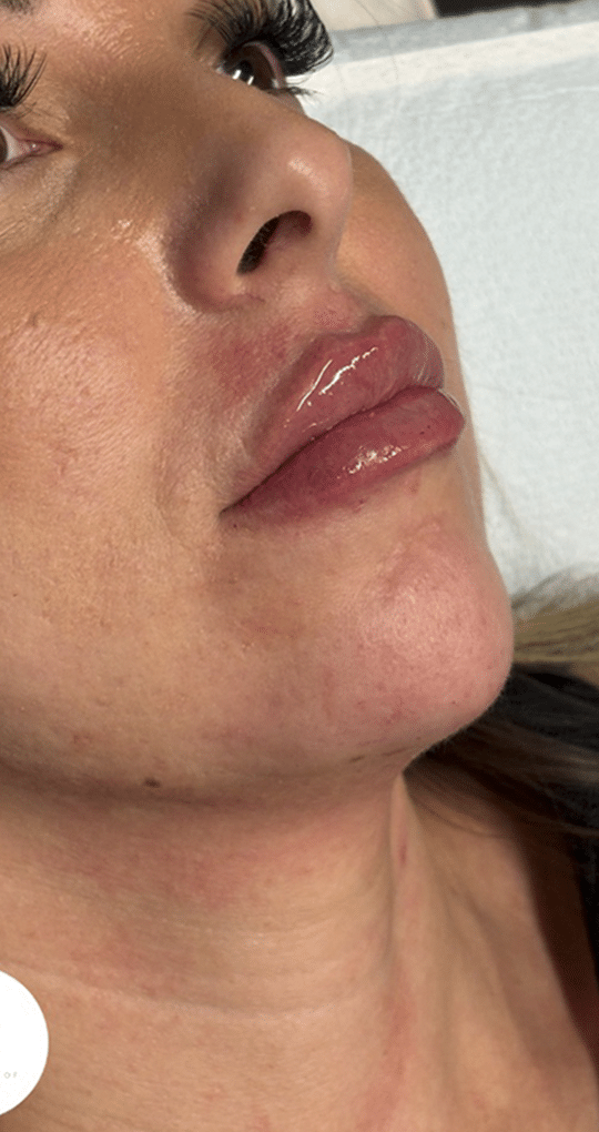 After Image: Lip Filler - right-front-oblique