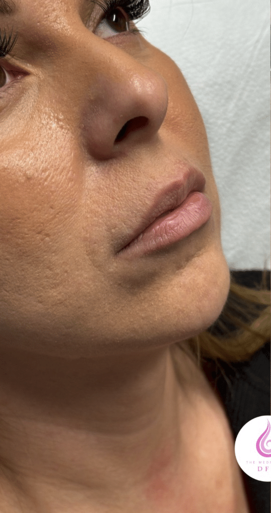 Before Image: Lip Filler - right-front-oblique
