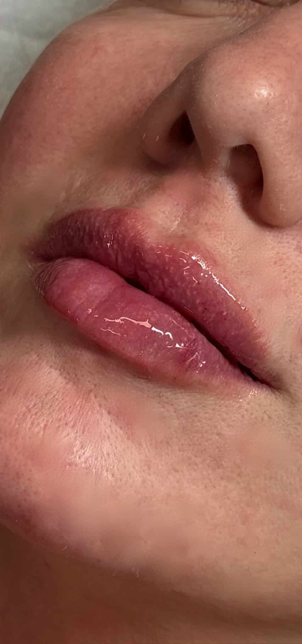 After Image: Lip Filler - left-front-oblique