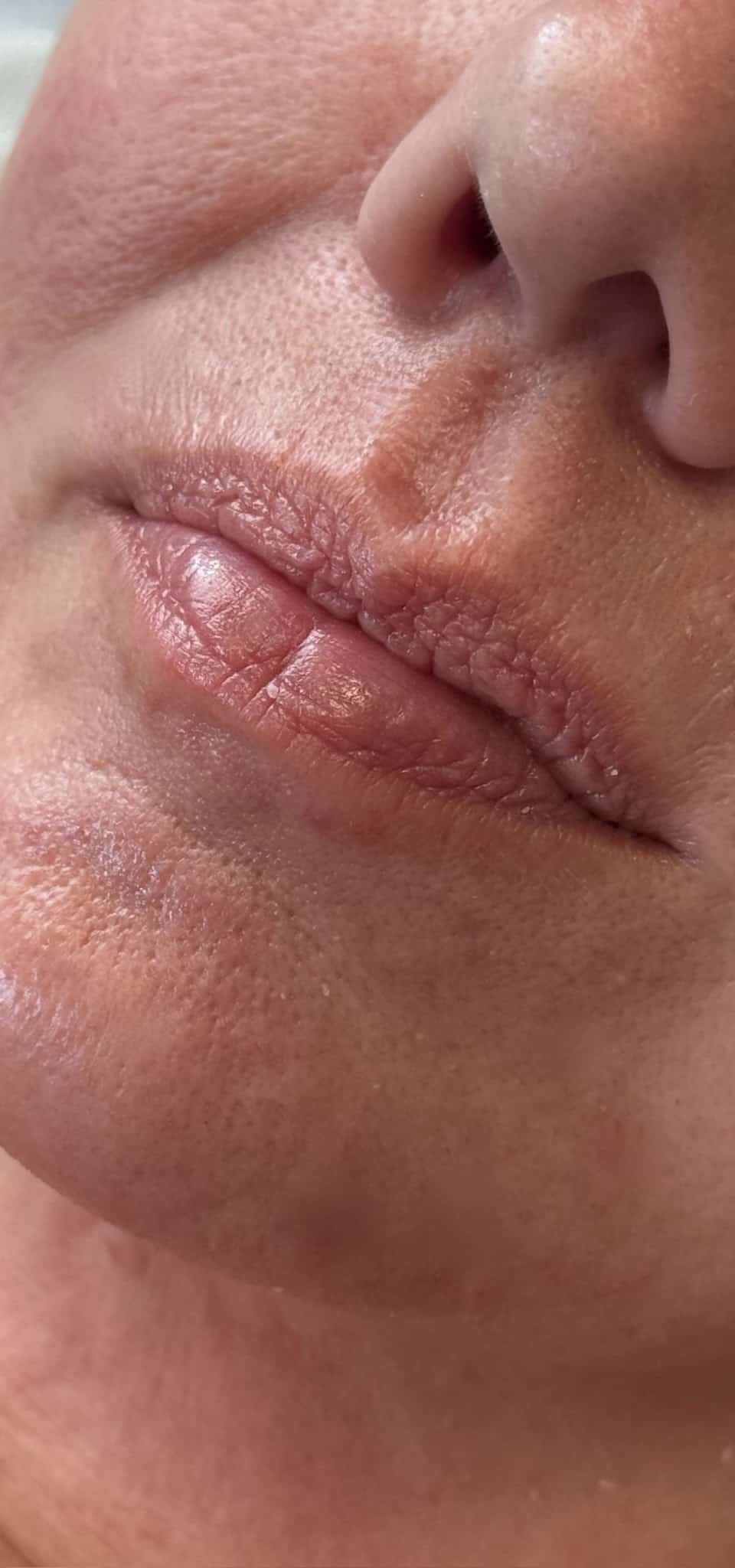 Before Image: Lip Filler - left-front-oblique