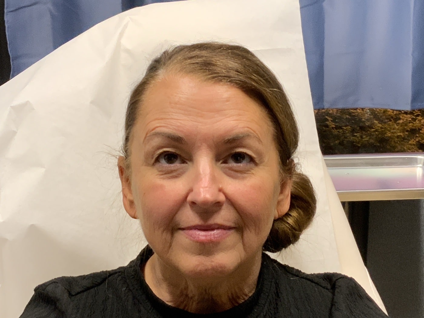 Before Image: Filler, Tox, VI Peel - front