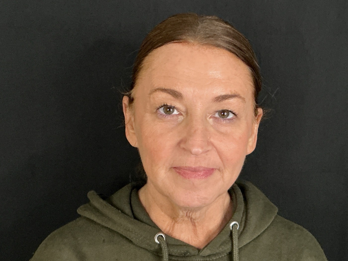 After Image: Filler, Tox, VI Peel - front