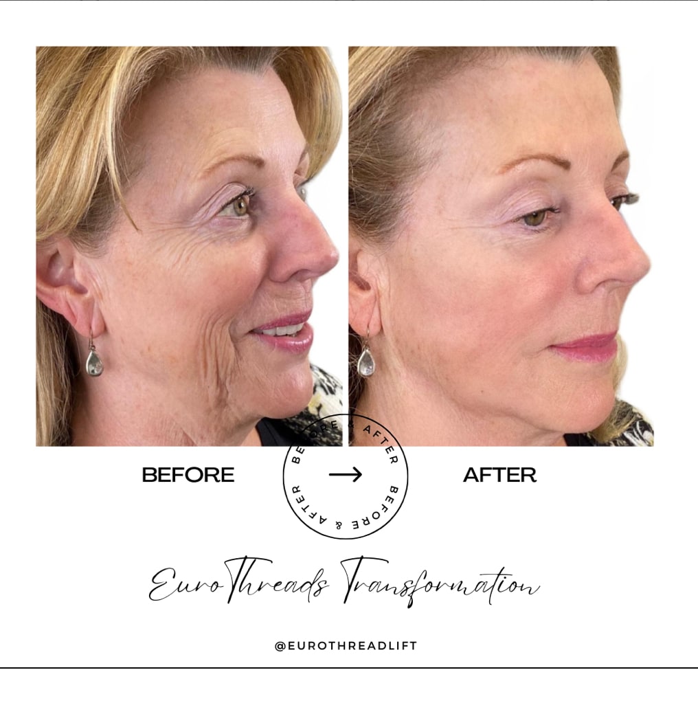 Before and After Image: Euro Threads Case 1 - front