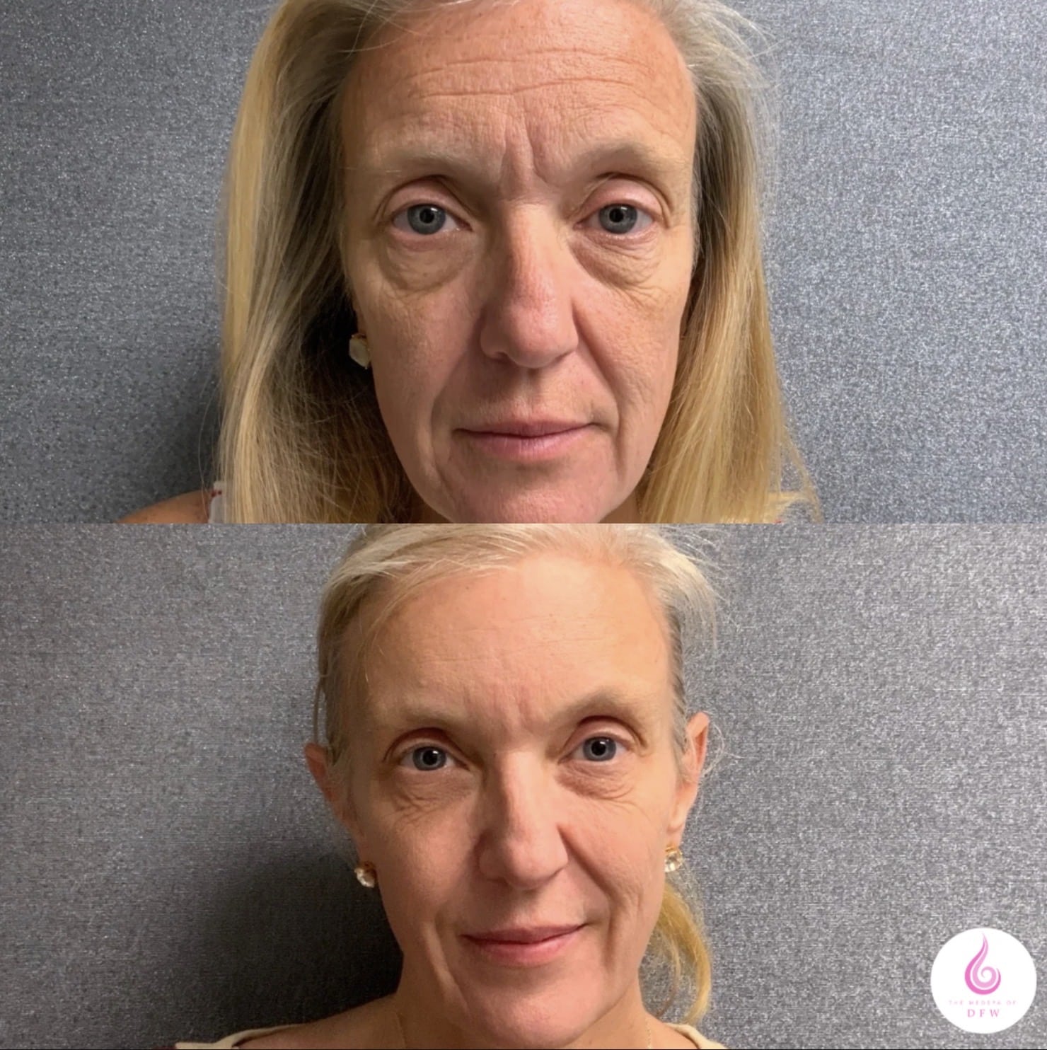 Before and After Image: Filler, Tox, VI Peels, Aerolase - front