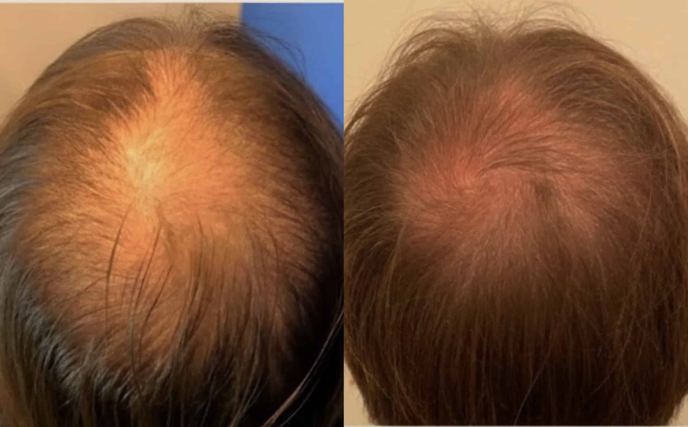 Before and After Image: Hair Restoration - front