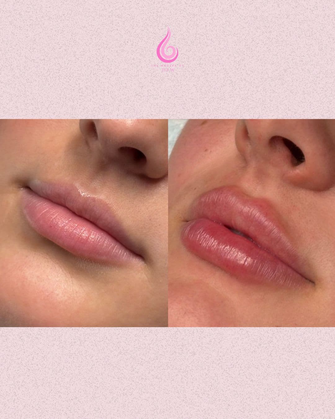 Before and After Image: Lip Filler - front