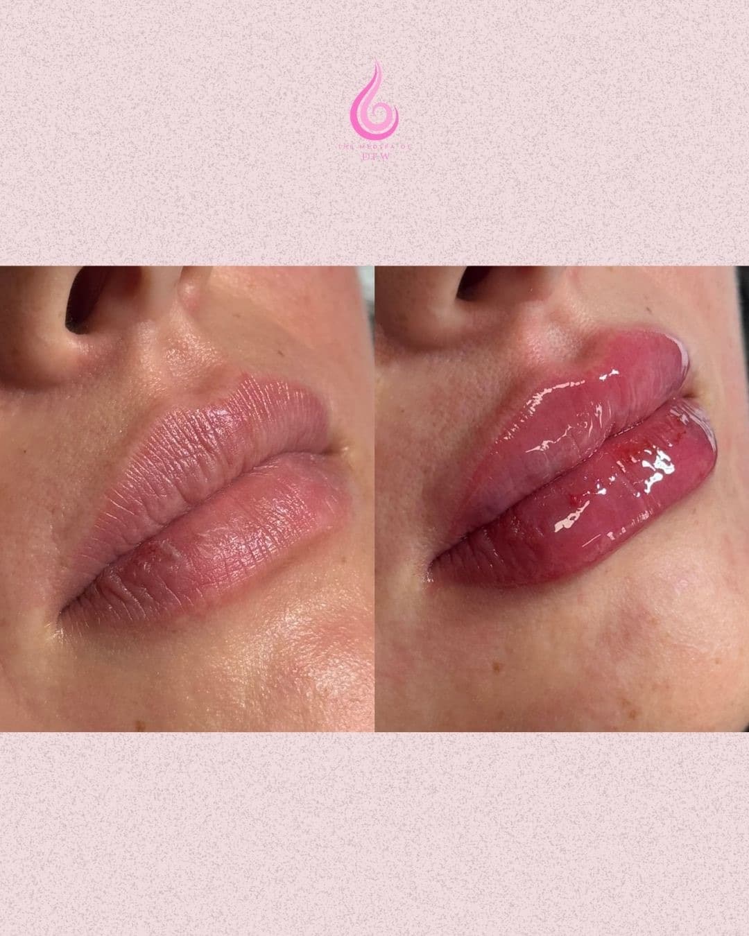 Before and After Image: Lip Filler - front